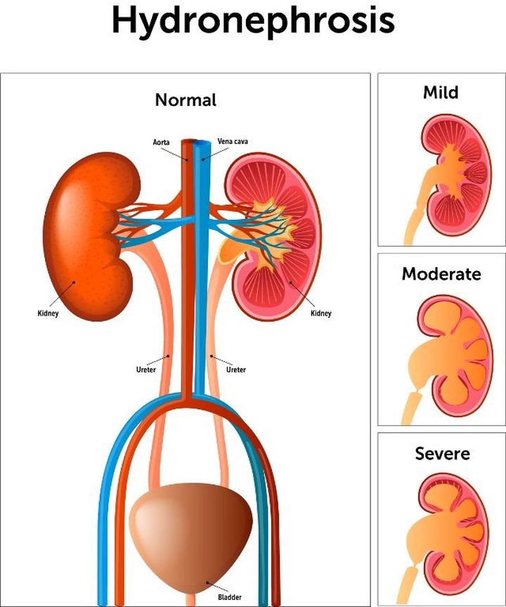 swollen-kidney-warning-signs-to-watch-out-for-major-causes-and