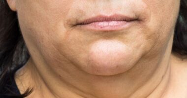 3 Helpful Tips To Lose Face Fat