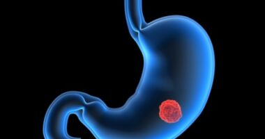 What Are The Warning Signs Of Stomach Cancer?.