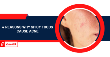 4 reasons why spicy foods cause acne