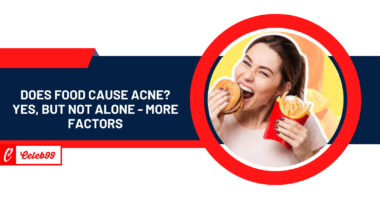 Does food cause acne? Yes, But Not Alone - More Factors