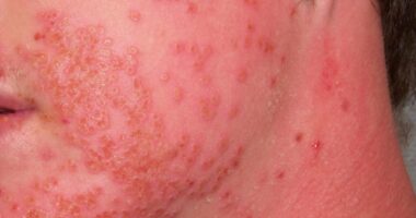 6 Common Eczema Triggers and What To Do About Them