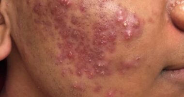 How Do I Get Rid Of My Pimples?