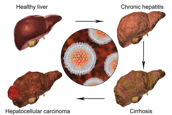 Early detection of hepatocellular carcinoma could be revolutionized by advanced AI techniques
