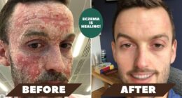 What Does Eczema Look Like When Healing?
