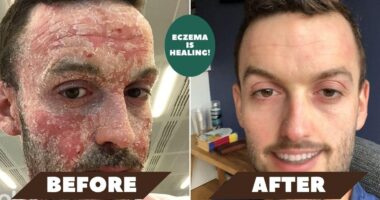 What Does Eczema Look Like When Healing?